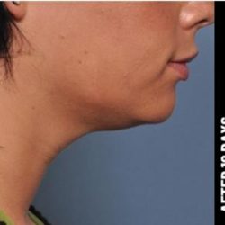 Ultherapy Before & After Patient #1548